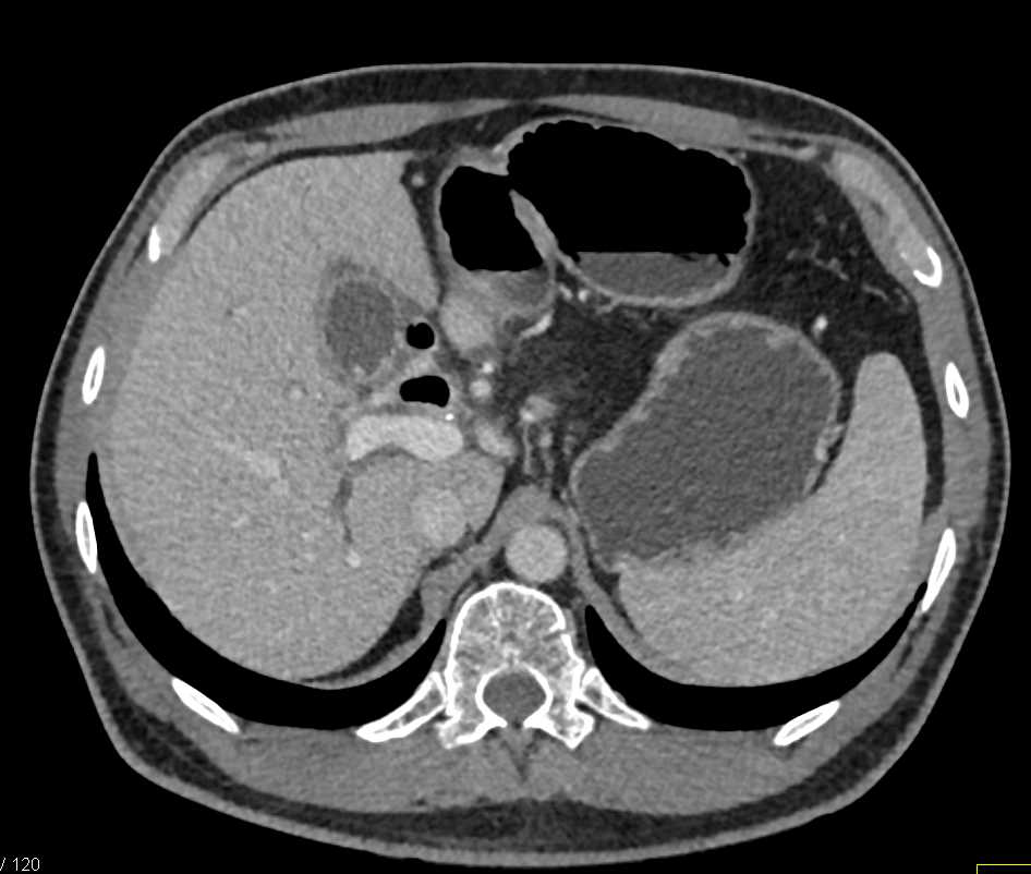 Inflammation Gallbladder Following Biliary Stent Placement - CTisus CT Scan