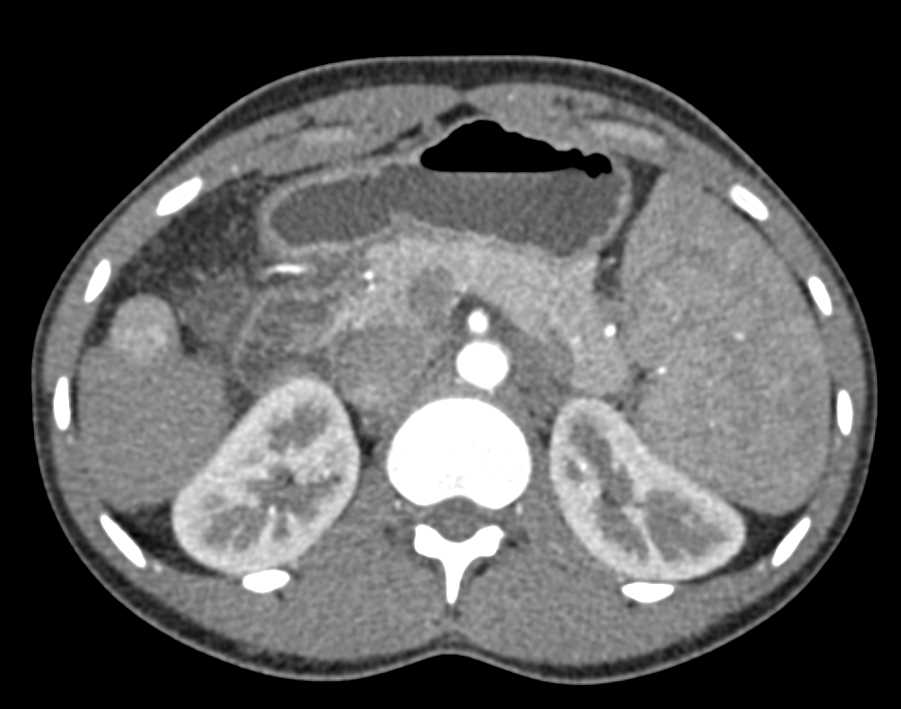 Hepatocellular Carcinoma (Hepatoma) in Cirrhotic Liver with Splenic Artery Aneurysms - CTisus CT Scan