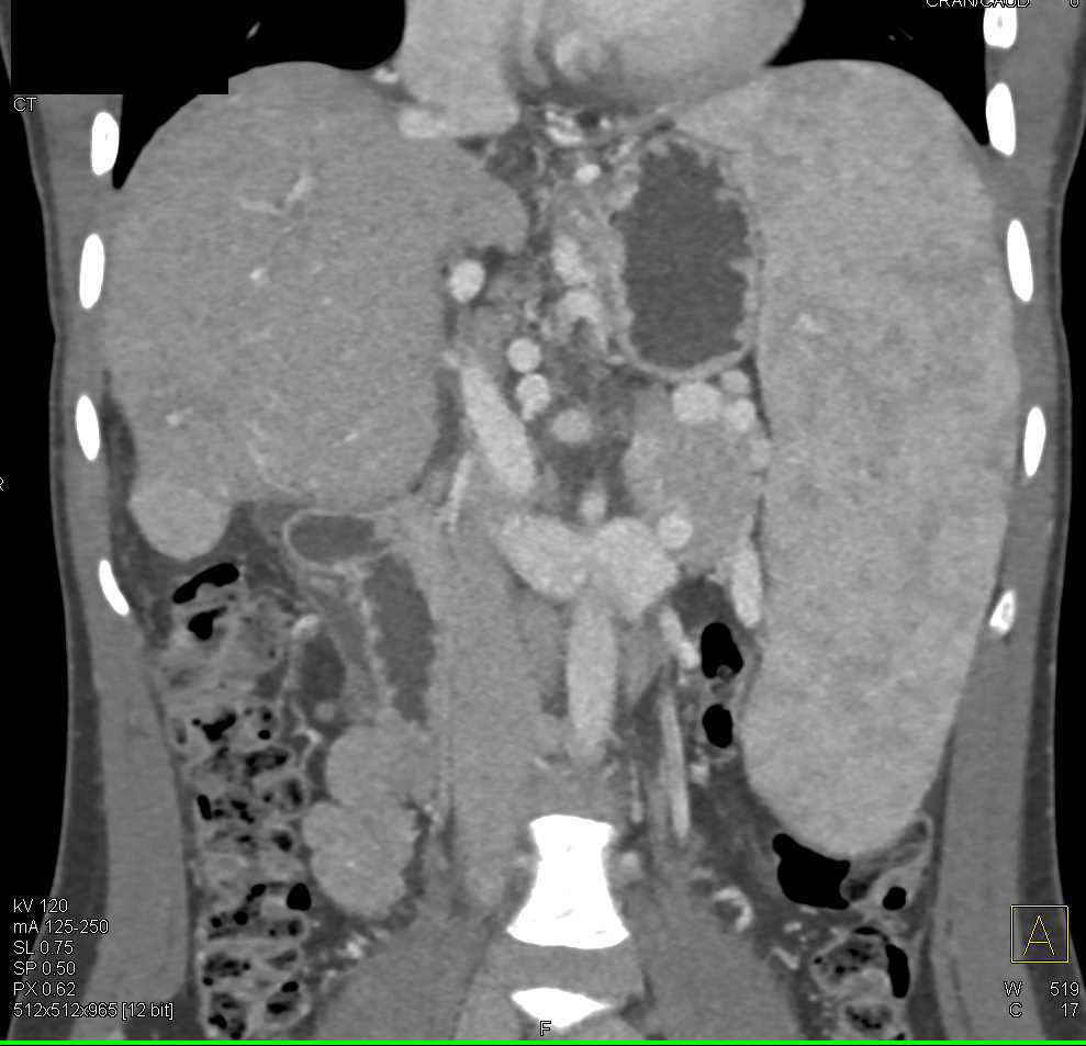 Hepatocellular Carcinoma (Hepatoma) in Cirrhotic Liver with Splenic Artery Aneurysms and Varices - CTisus CT Scan