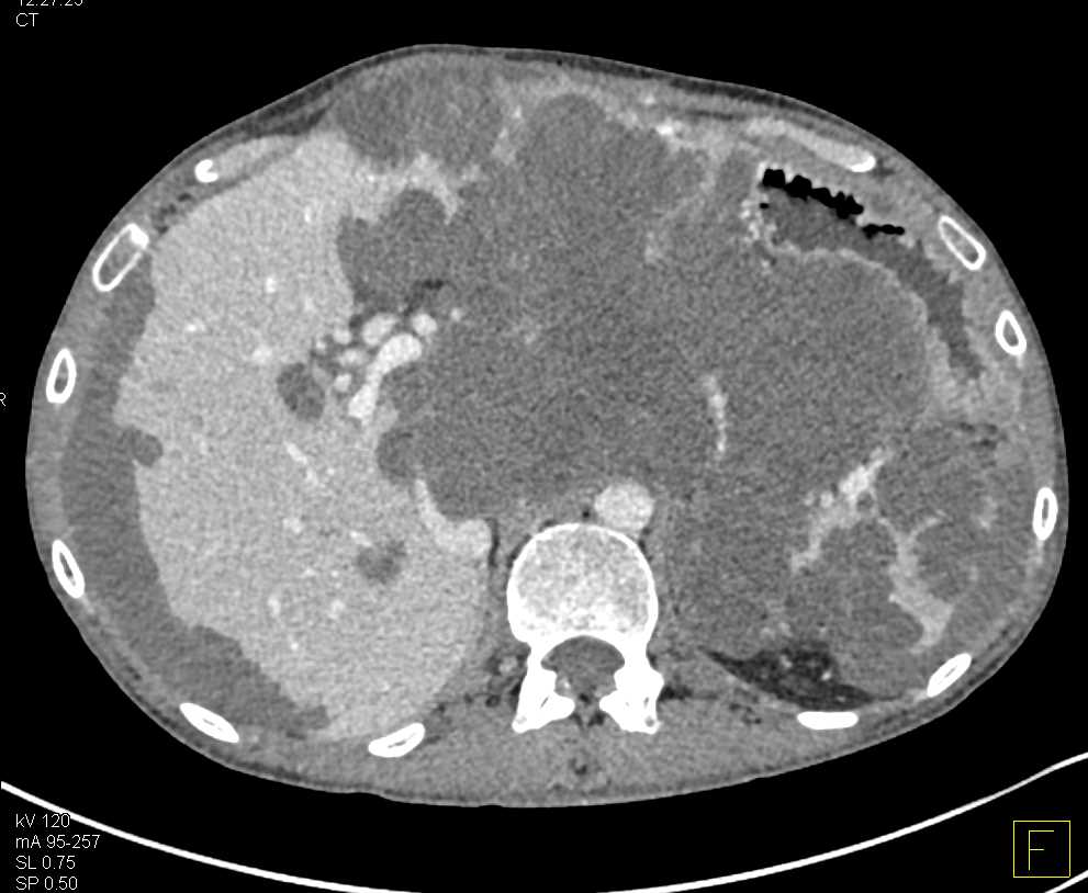 Pseudomyxoma Peritonei (PMP) with Scalloping of the Liver Margins - CTisus CT Scan