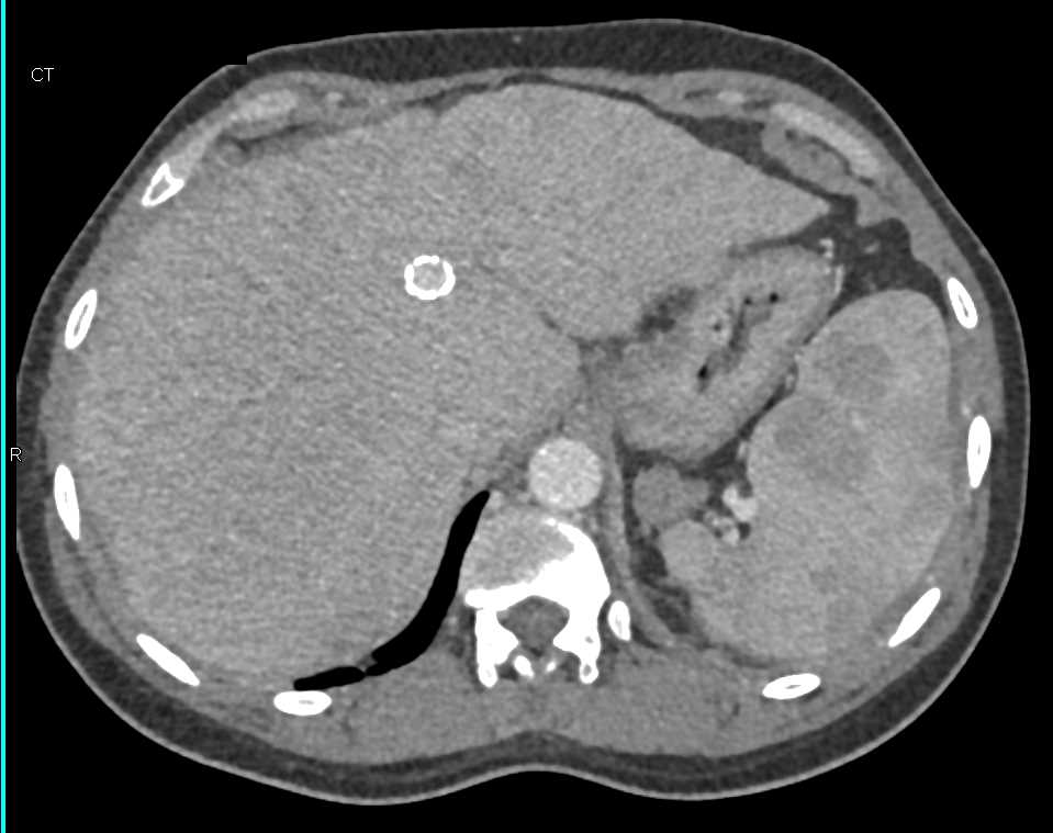 Cirrhosis with Portal Hypertension and Varices and Transjugular Intrahepatic Portosystemic Shunt (TIPS) in Place - CTisus CT Scan