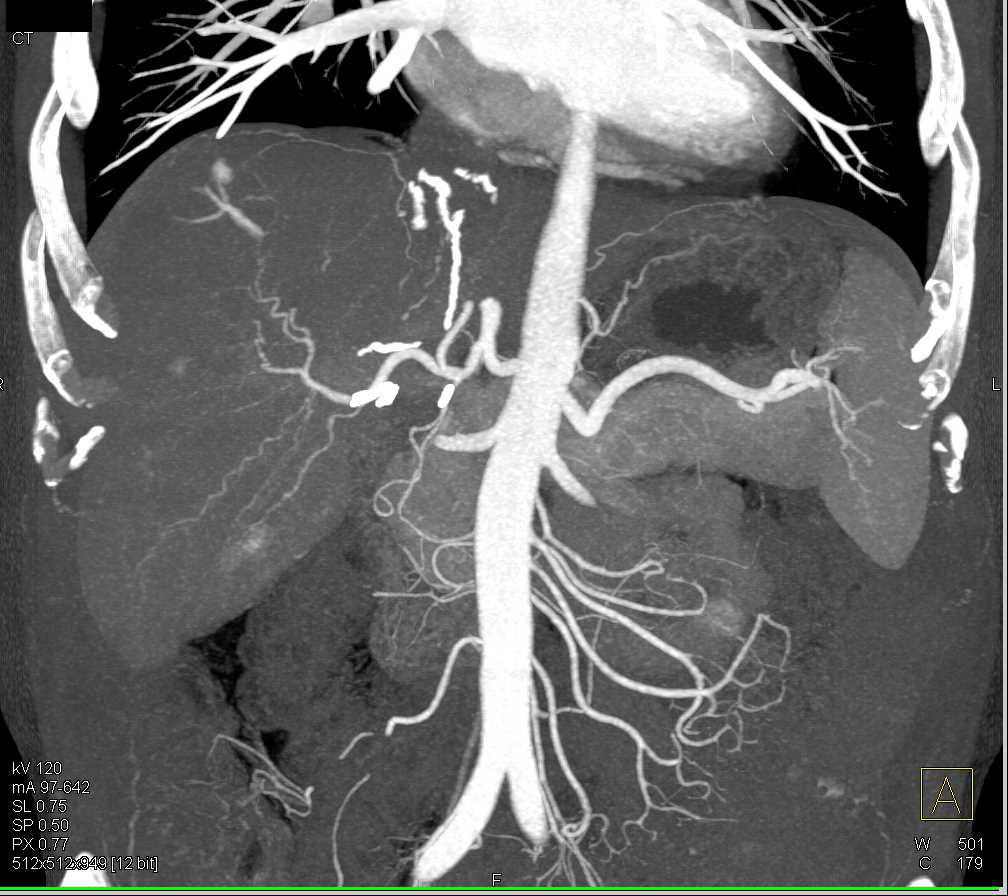 Metastatic Renal Cell Carcinoma to the Liver - CTisus CT Scan