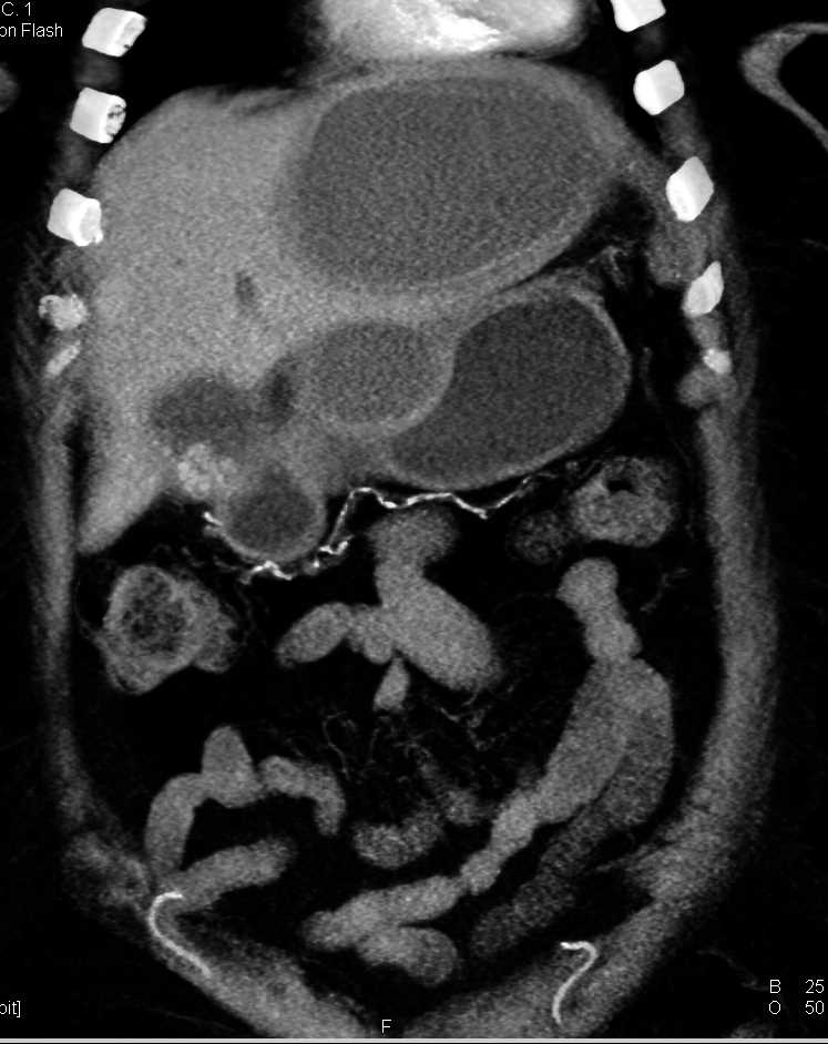 Cystic Liver Metastases from GIST Tumor - CTisus CT Scan