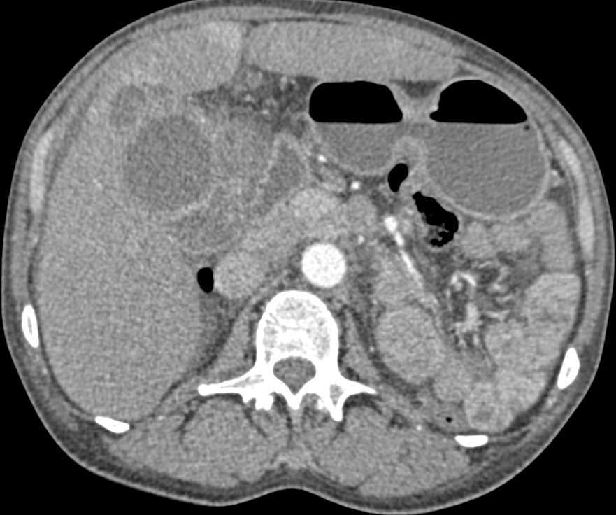 Hepatocellular Carcinoma (Hepatoma) s/p Chemoembolization - CTisus CT Scan