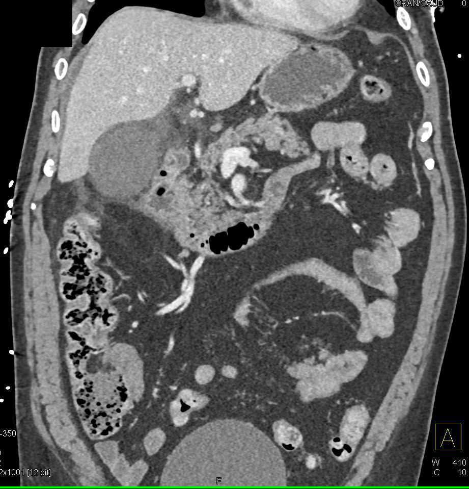 Acute Cholecystitis - CTisus CT Scan