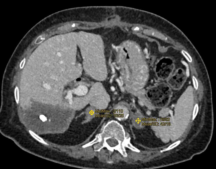 Sclerosing Hepatic Hemangioma - CTisus CT Scan