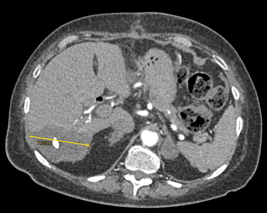 Sclerosing Hepatic Hemangioma - Liver Case Studies - CTisus CT Scanning