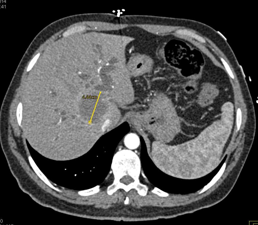 Cholangiocarcinoma of the Liver - CTisus CT Scan