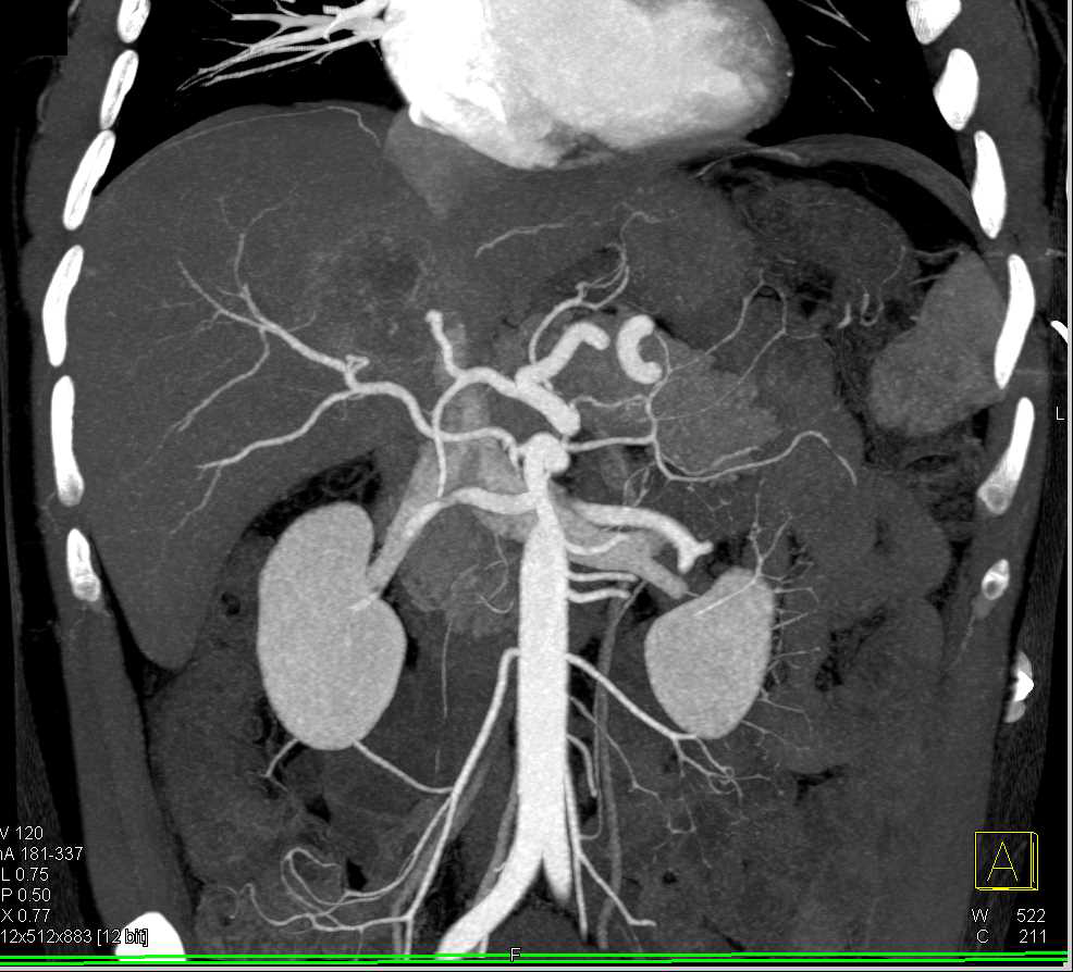 Cholangiocarcinoma of the Liver - CTisus CT Scan