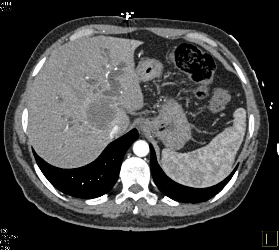 Cholangiocarcinoma of the Liver - CTisus CT Scan