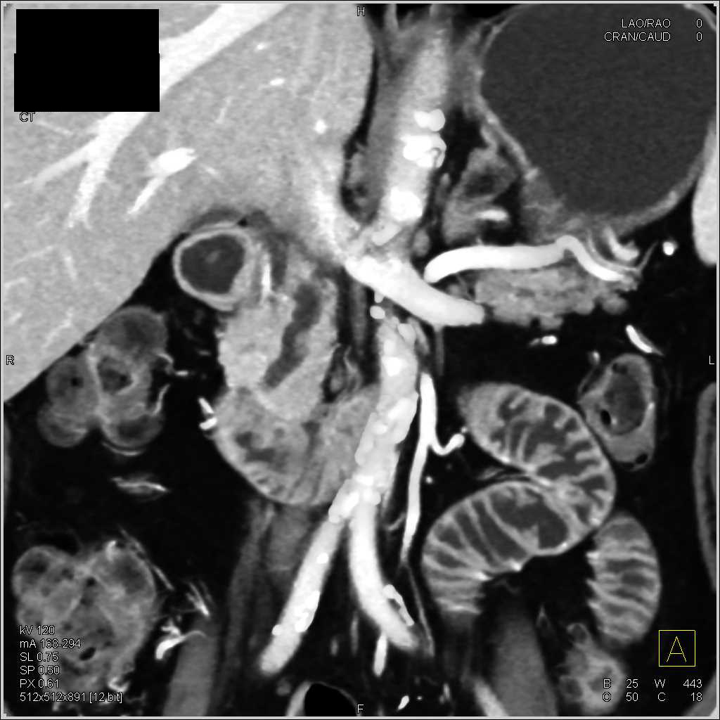 Non-Opaque Stone in the Distal Common Bile Duct - CTisus CT Scan