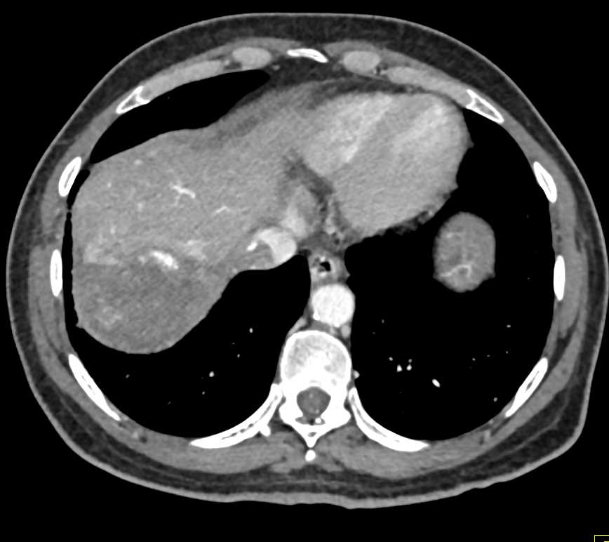 Hepatocellular Carcinoma (Hepatoma) - CTisus CT Scan