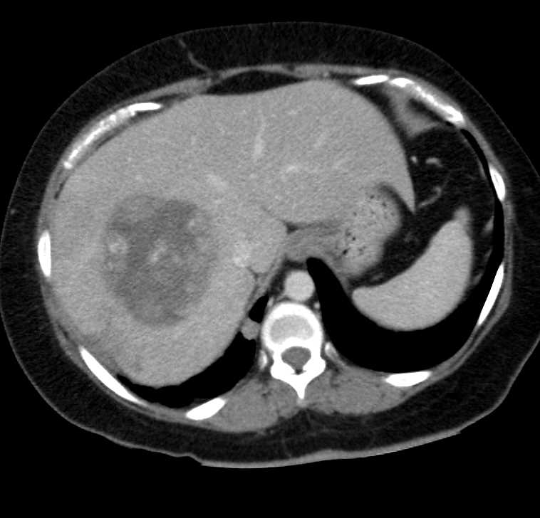 Hepatocellular Carcinoma (Hepatoma) with Right Adrenal Metastases - CTisus CT Scan