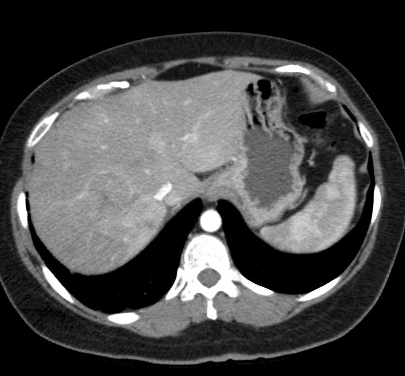 Hepatocellular Carcinoma (Hepatoma) with Right Adrenal Metastases - CTisus CT Scan