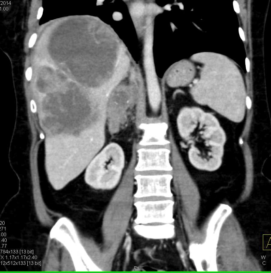 Necrotic Liver Metastases and Right Adrenal Metastases - CTisus CT Scan