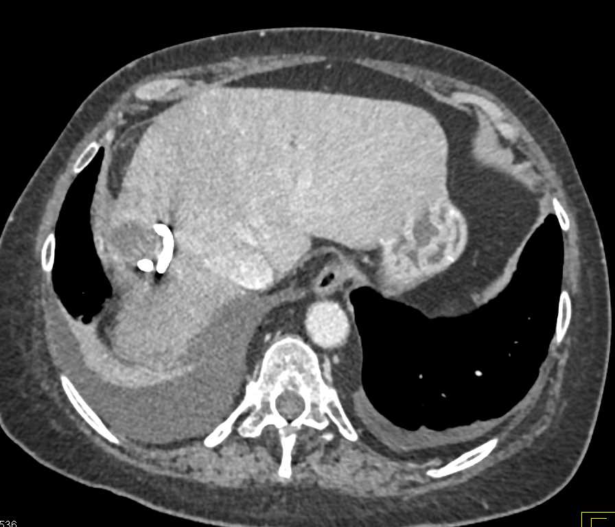 Biloma S/P Hepatocellular Carcinoma (Hepatoma) Resection with 2 Sets of Imaging - CTisus CT Scan