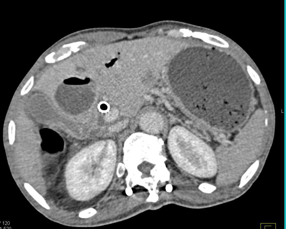 Liver Abscess with Biliary Stent - CTisus CT Scan
