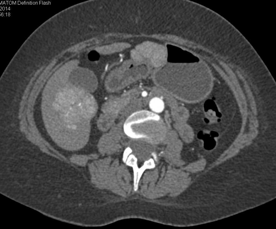 Classic Focal Nodular Hyperplasia Liver - CTisus CT Scan