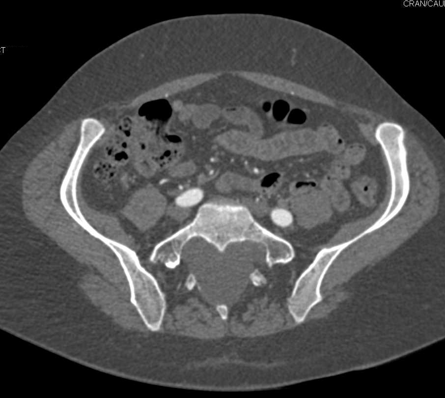 Classic Focal Nodular Hyperplasia Liver with Multiple Lesions in a Patient with Marfan Syndrome - CTisus CT Scan