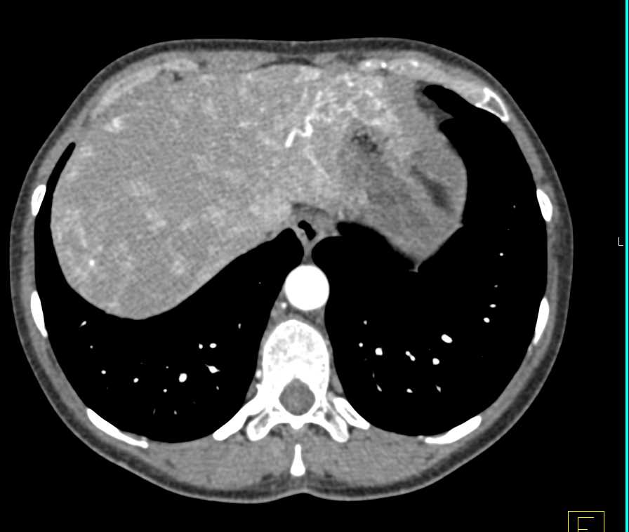 Hepatic Arteriovenous Malformations (AVMs) in a Patient with Hereditary Hemorrhagic Telangiectasia (HHT) Disease - CTisus CT Scan