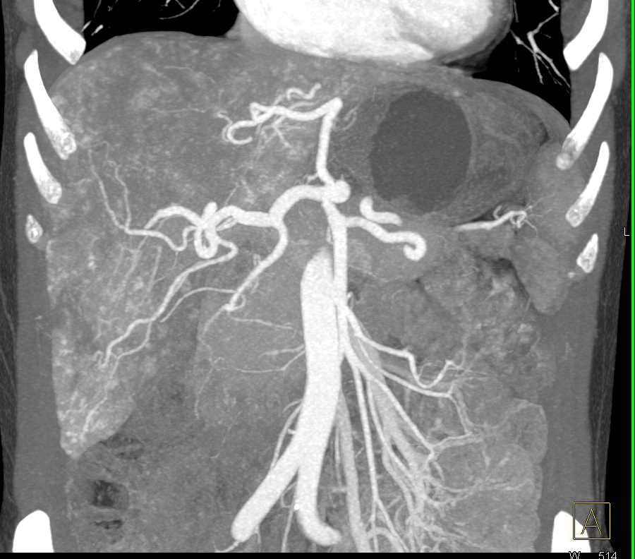 Hepatic Arteriovenous Malformations Avms In A Patient With Hereditary Hemorrhagic