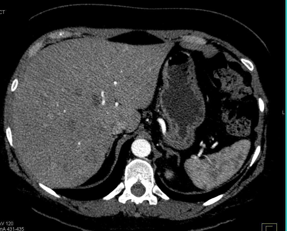 Hepatocellular Carcinoma (Hepatoma) with Arteriovenous (AV) Shunting - CTisus CT Scan