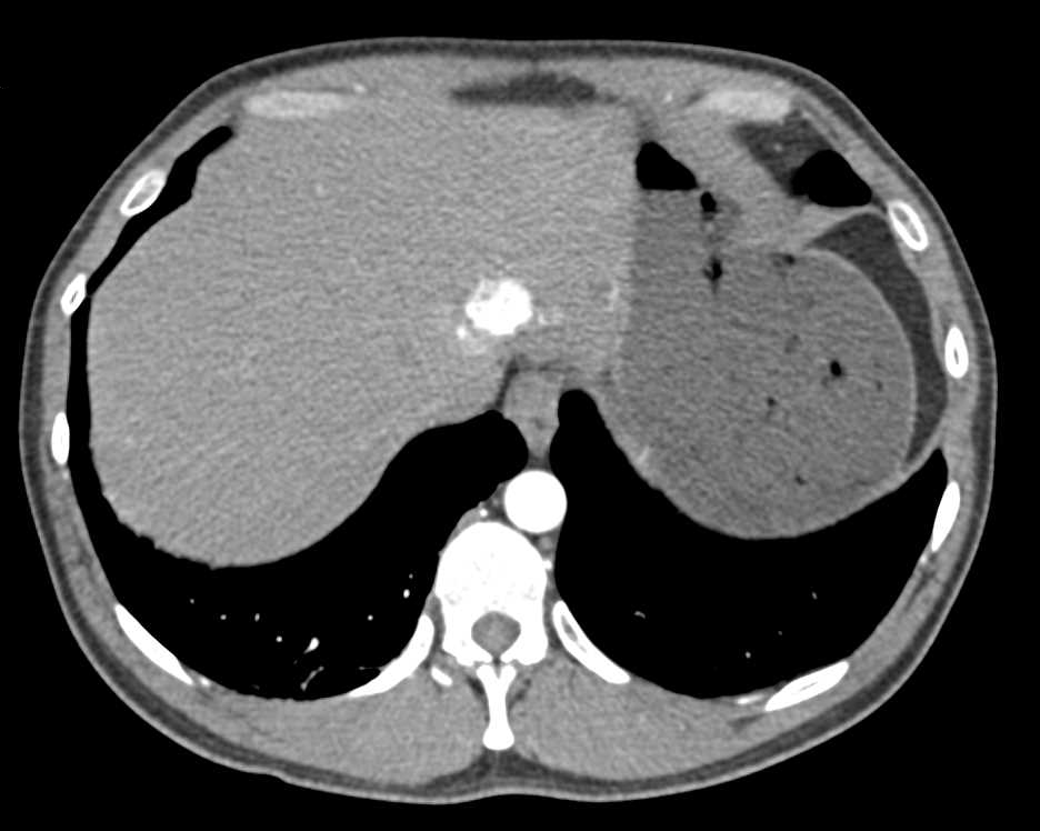 Metastatic Neuroendocrine Tumor to the Liver - CTisus CT Scan