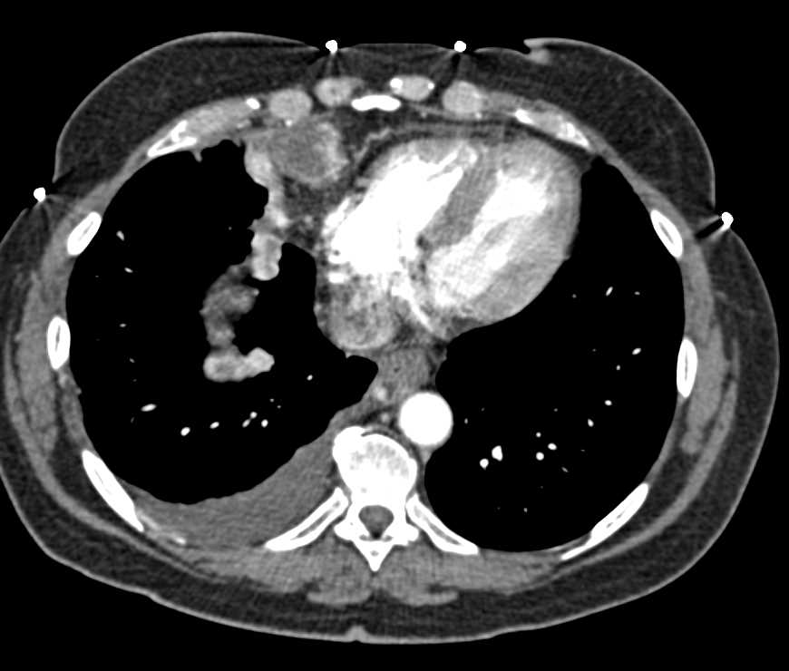 Metastatic Carcinoid Tumor with Vascular Implants - CTisus CT Scan