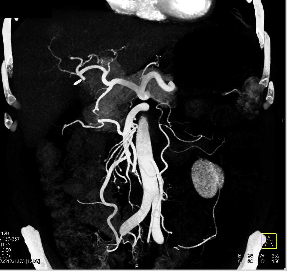 Focal Nodular Hyperplasia (FNH) or Focal Nodular Hyperplasia of the Liver - CTisus CT Scan