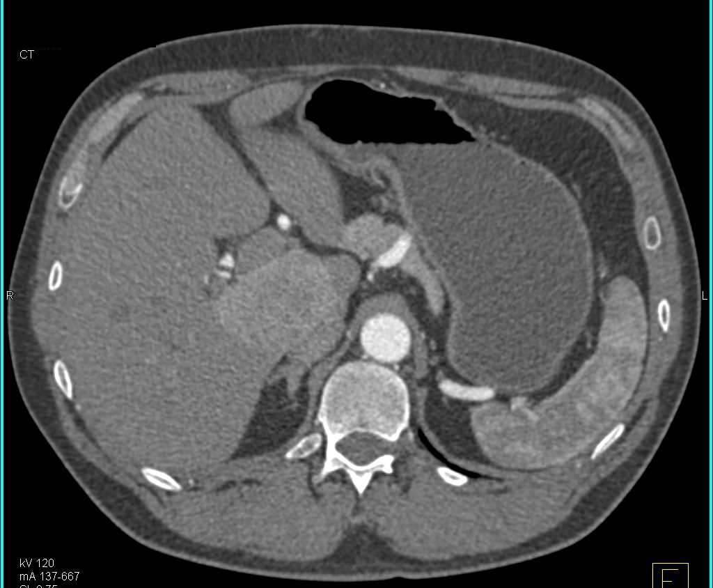 Focal Nodular Hyperplasia (FNH) or Focal Nodular Hyperplasia of the Liver - CTisus CT Scan