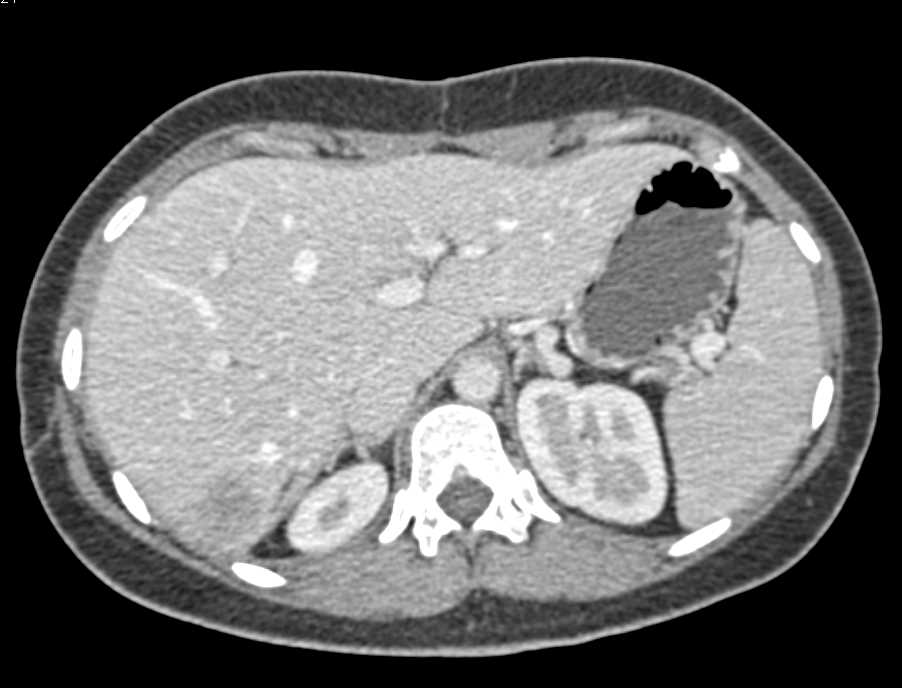 Metastatic Colon Cancer to the Liver - Liver Case Studies - CTisus CT