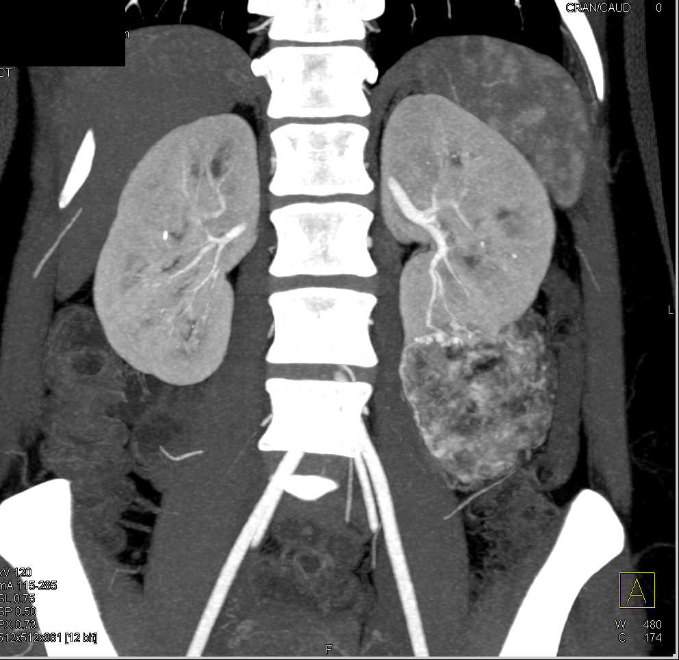 Angiomyelolipoma (AML) Left Kidney and Lipomas in the Liver - CTisus CT Scan