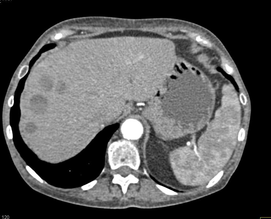 Necrotic GIST Tumor with Increased Vascularity and Liver Metastases - CTisus CT Scan