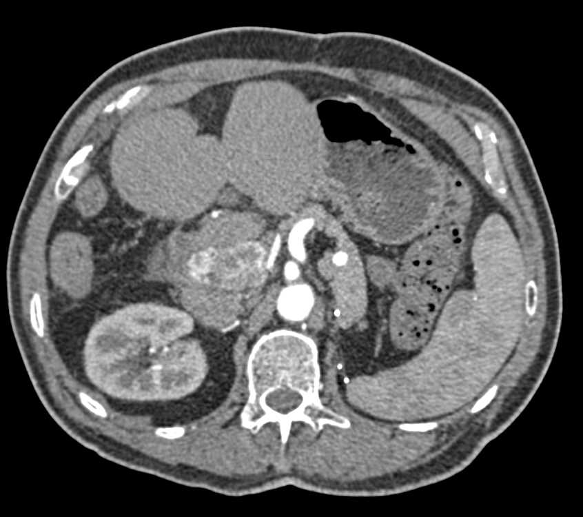 Recurrent Hepatocellular Carcinoma (Hepatoma) Involves the Portal Vein - CTisus CT Scan