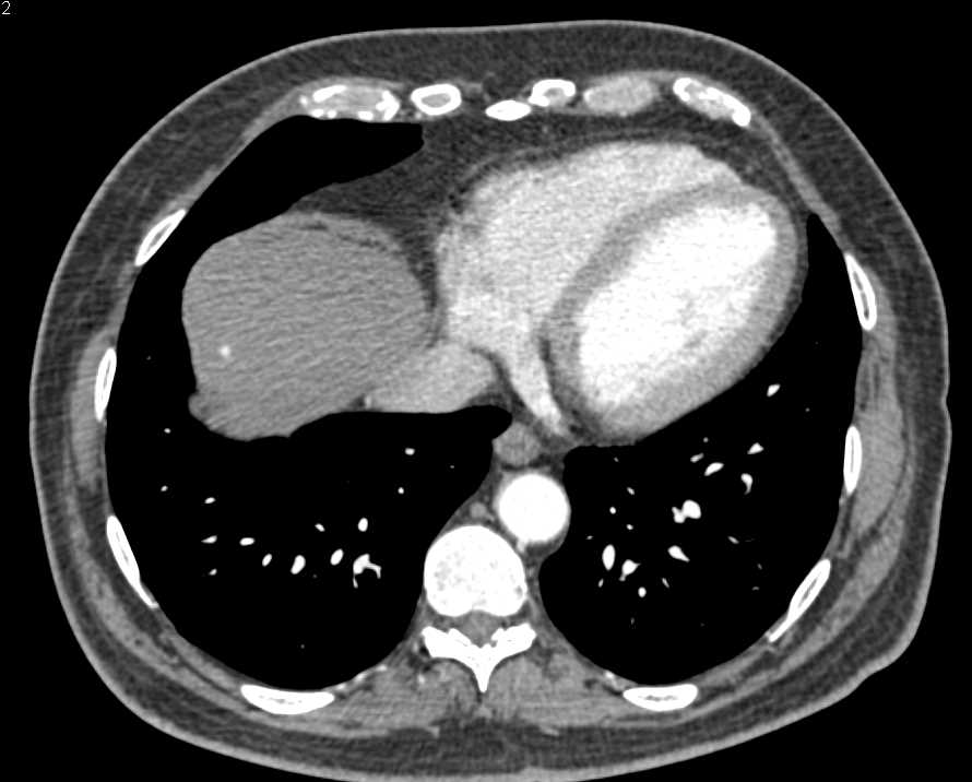 3 mm Vascular Lesion Liver was Hemangioma - CTisus CT Scan