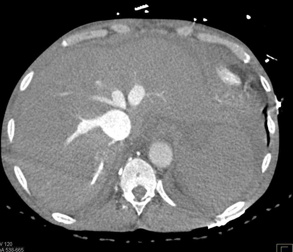 Poor Cardiac Function with Reflux into the Inferior Vena Cava (IVC) and Hepatic Veins - CTisus CT Scan