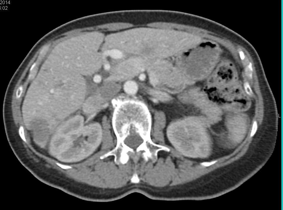 Metastatic Adenocarcinoma to the Liver - CTisus CT Scan