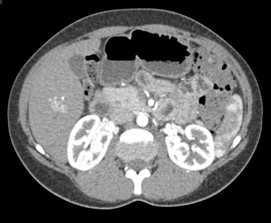 Focal Nodular Hyperplasia (FNH) Left Lobe of Liver and Hemangioma in the Right Lobe - CTisus CT Scan