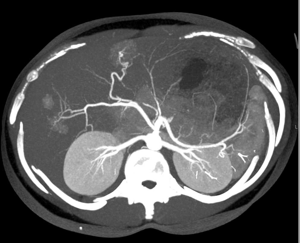 Focal Nodular Hyperplasia (FNH) Left Lobe of Liver and Hemangioma in the Right Lobe - CTisus CT Scan