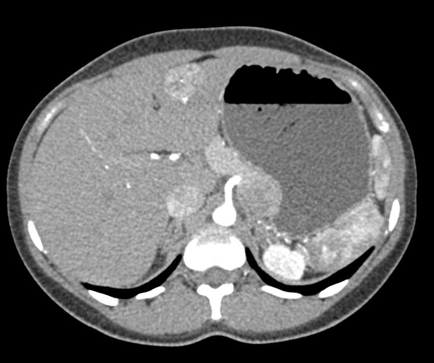 Focal Nodular Hyperplasia (FNH) Left Lobe of Liver and Hemangioma in the Right Lobe - CTisus CT Scan