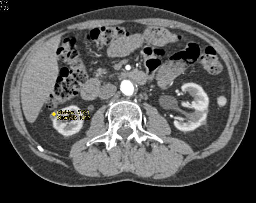 Hereditary Hemorrhagic Telangiectasia (HHT) Disease with Hepatic Arteriovenous Malformation (AVM) Seen on MIP Imaging - CTisus CT Scan