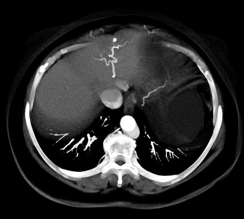 Liver Infarction Looks Like a Tumor - CTisus CT Scan