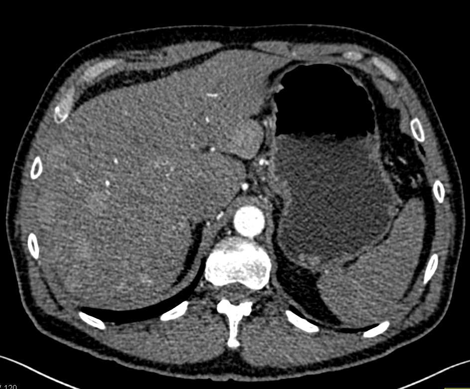 Subtle Metastatic Neuroendocrine Tumor to the Liver - CTisus CT Scan