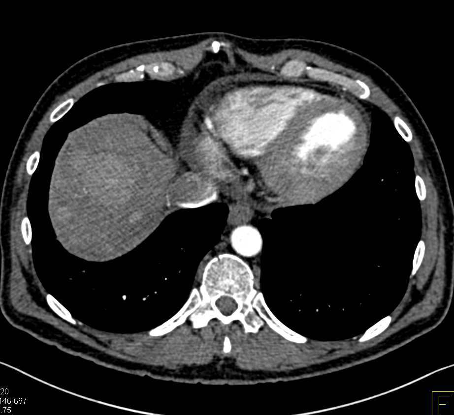 Subtle Metastatic Neuroendocrine Tumor to the Liver - CTisus CT Scan