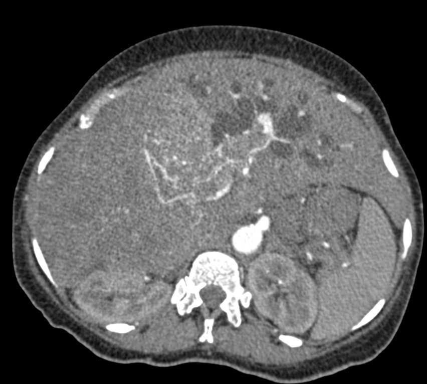 Hepatocellular Carcinoma (Hepatoma) with Portal Vein Invasion - CTisus CT Scan