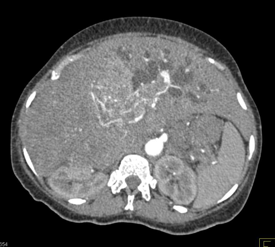 Hepatocellular Carcinoma (Hepatoma) with Portal Vein Invasion and Dilated Ducts in Left Lobe of the Liver - CTisus CT Scan