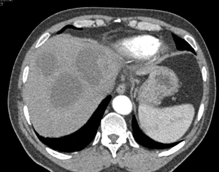 Multiple Liver Abscesses - CTisus CT Scan