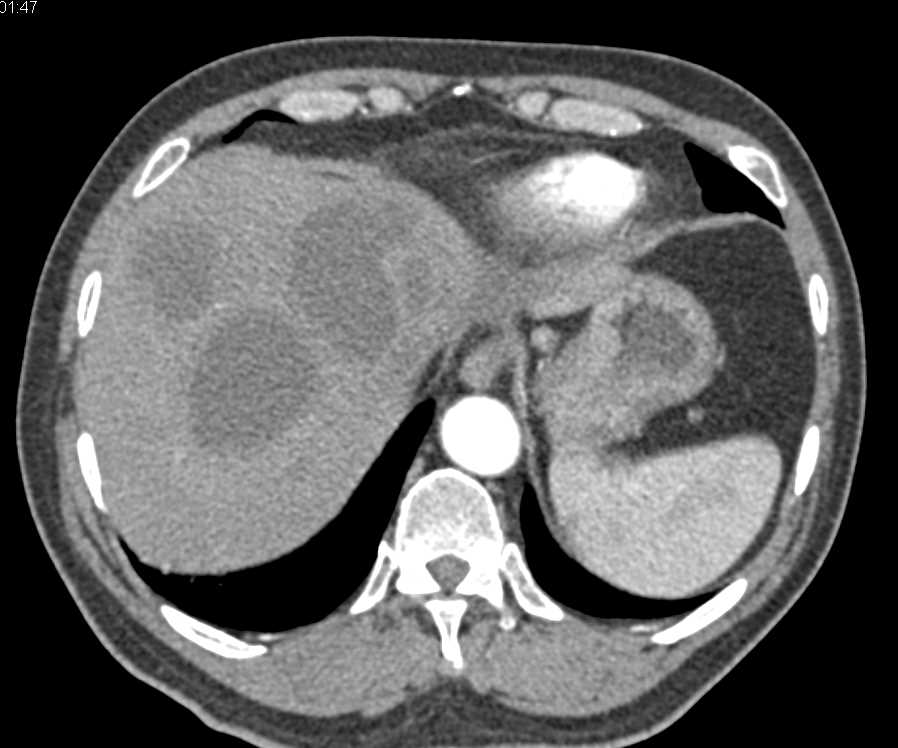 Multiple Liver Abscesses - CTisus CT Scan