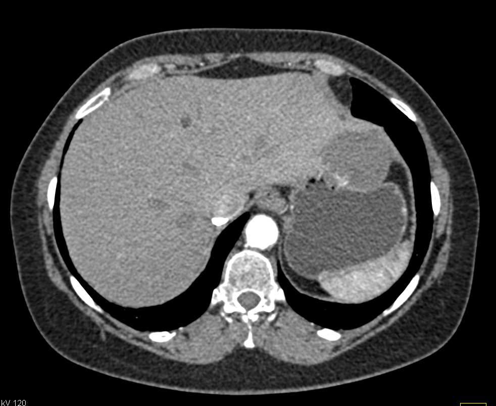 Hemangioma Left Lobe of the Liver - CTisus CT Scan