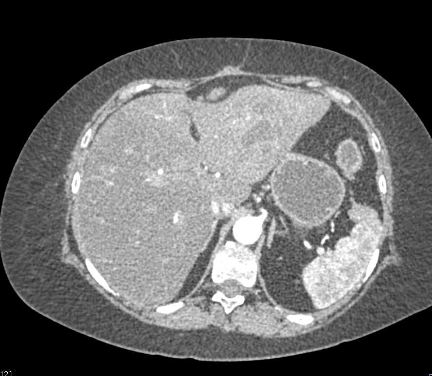 Prior Hematoma Left Lobe of the Liver - CTisus CT Scan